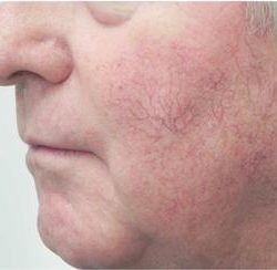 Excel V - Cutera Before & After Patient #1662